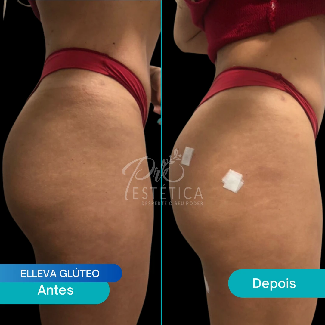 elleva-gluteo (1) elleva-gluteo (1)
