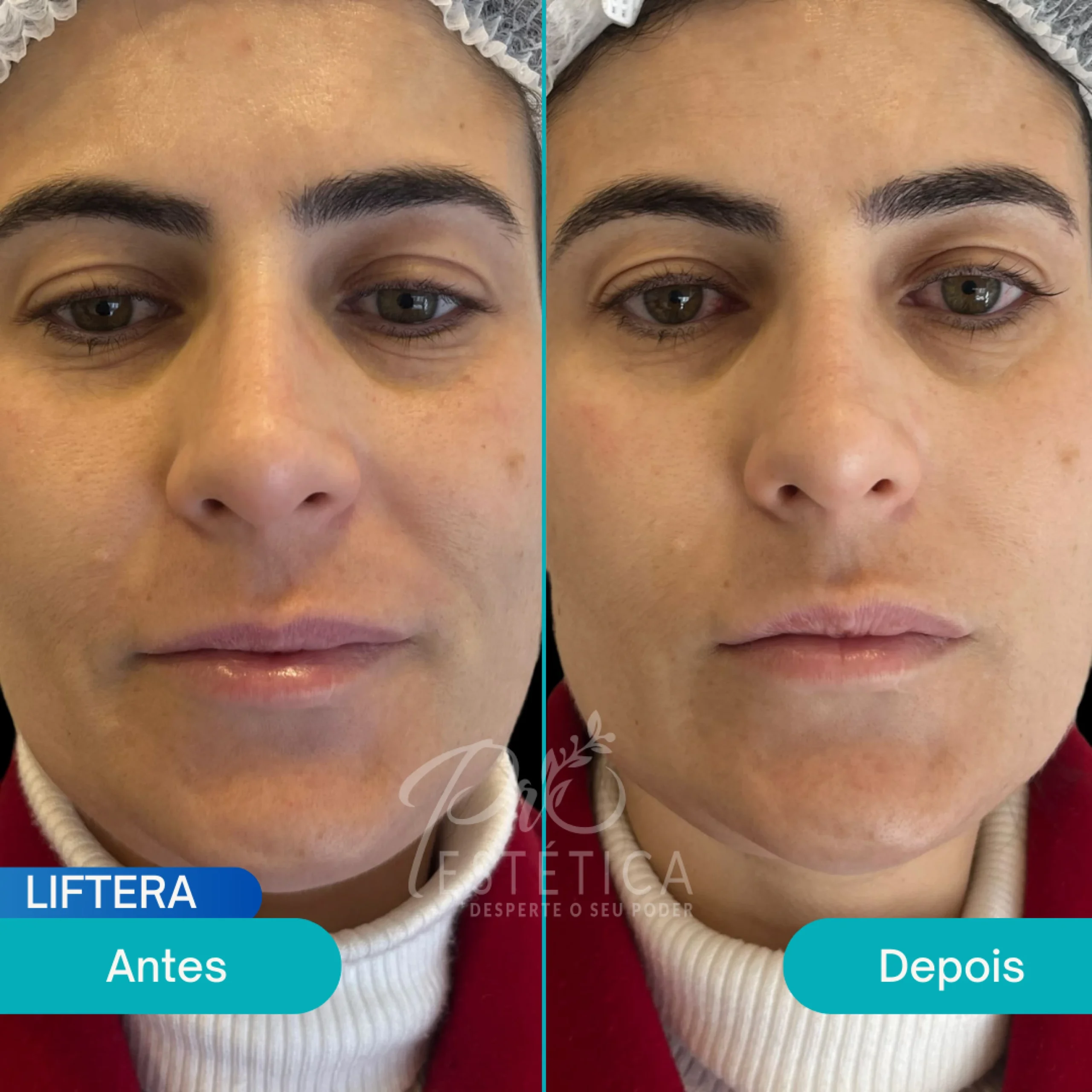 liftera (1) liftera (1)