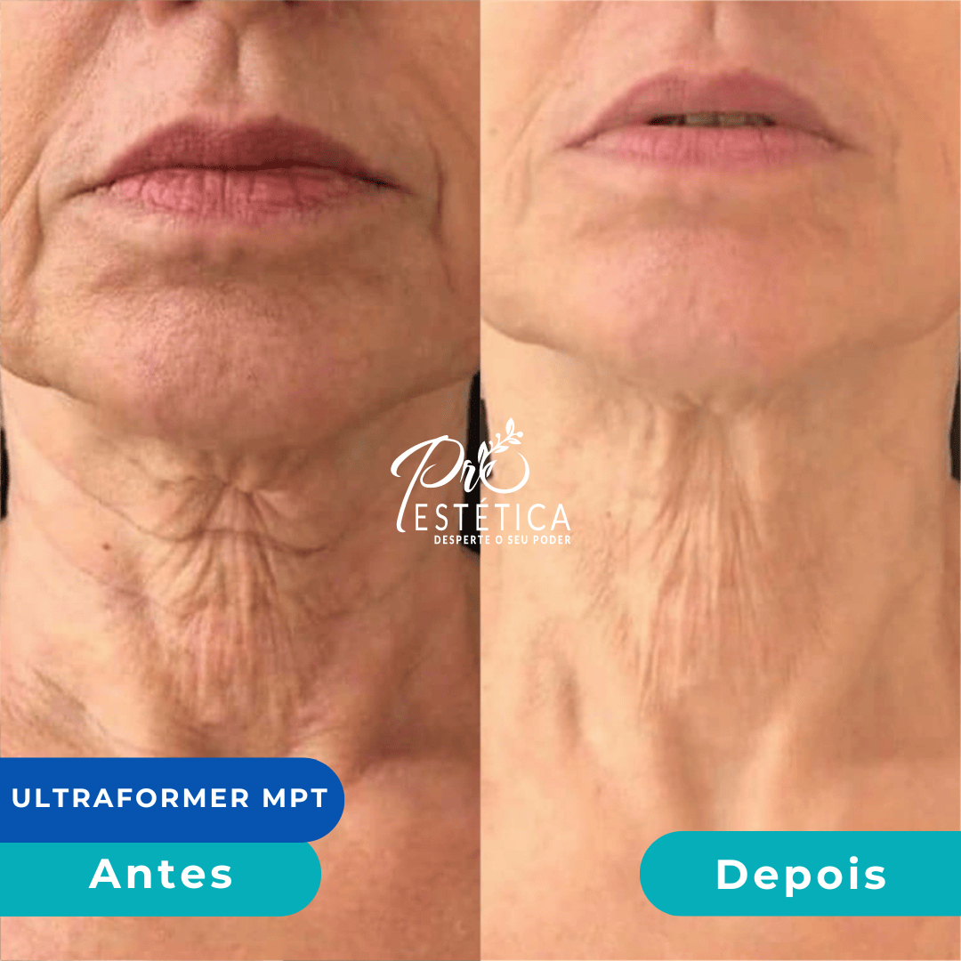 antes_e_depois_10__1x antes_e_depois_10__1x