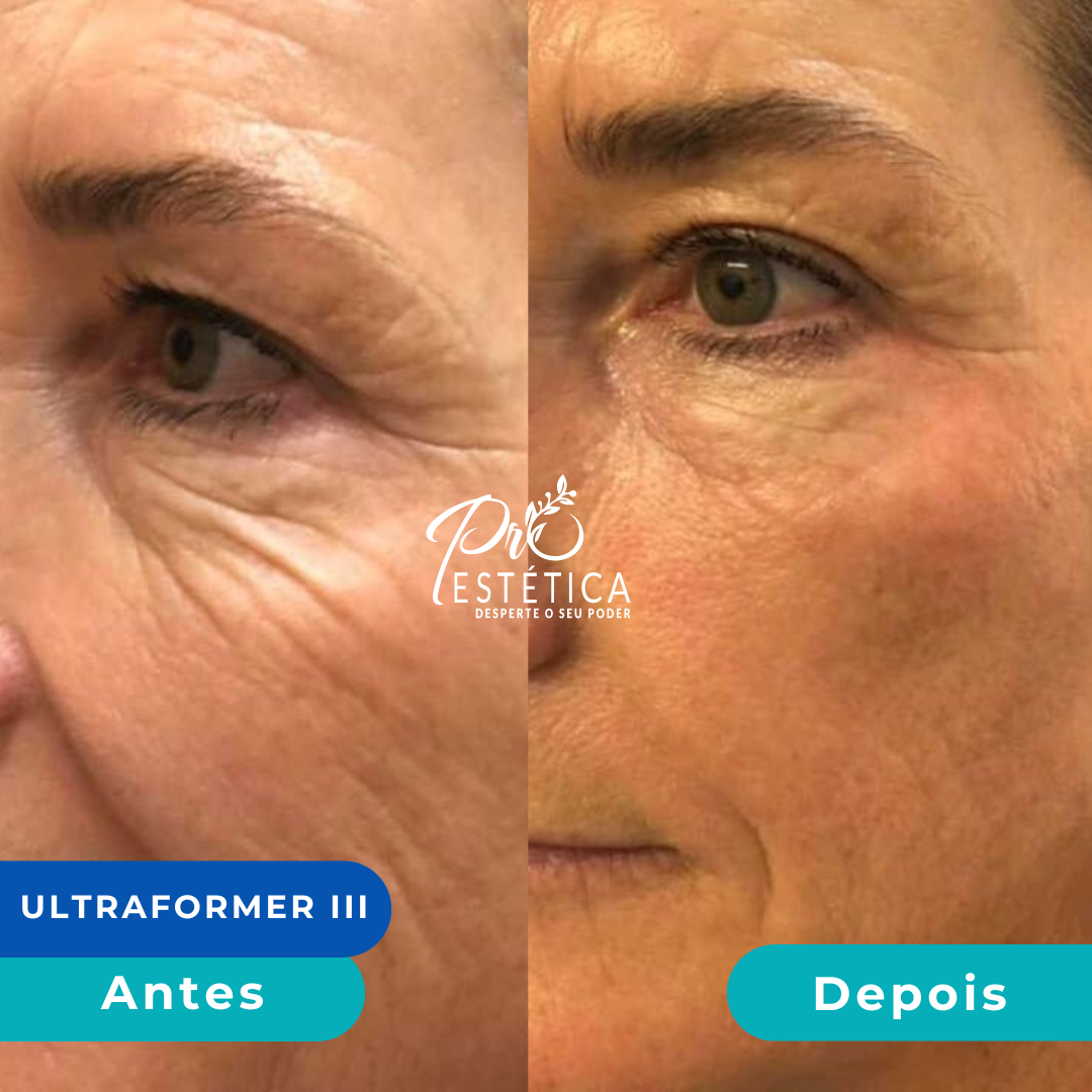 antes_e_depois_14__1x antes_e_depois_14__1x