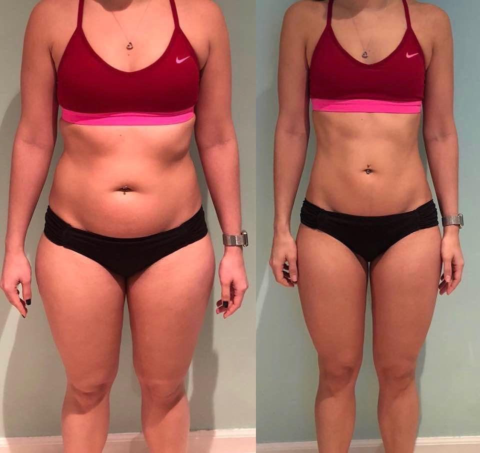 IMG_3371 Antes e depois Mounjaro - Pró Estética